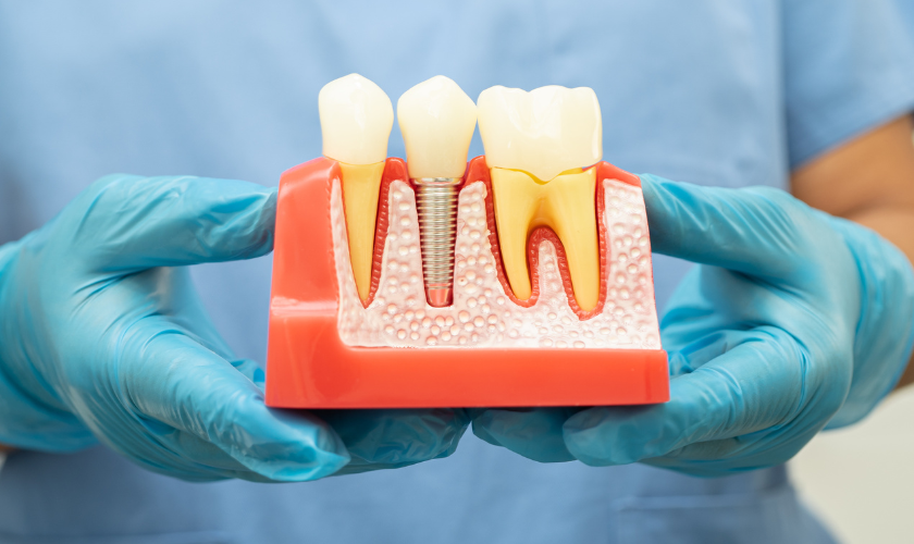The Long-Term Benefits of Dental Implants